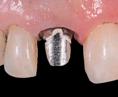 Luxatemp PLUS - старый абатмент